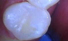 After picture with the cavity removed and restored.