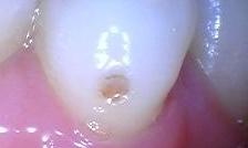 Cavity within the tooth